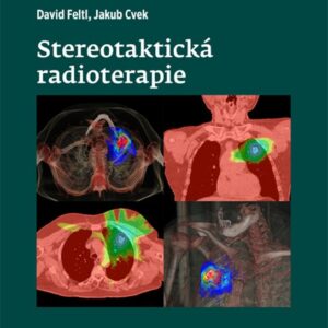 Stereotaktická radioterapie (Jakub Cvek) (česky)